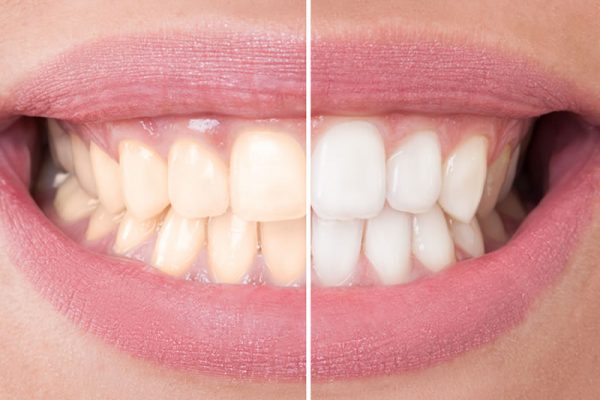 comestic-dentistry-teeth-whitening comestic-dentistry-teeth-whitening