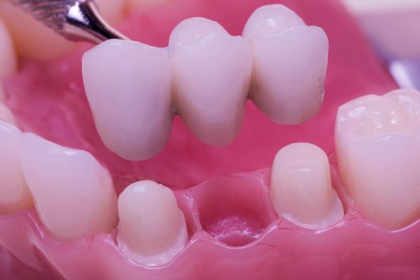 comestic-dentistry-bridges