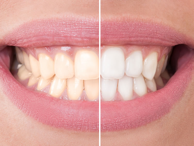 comestic-dentistry-teeth-whitening