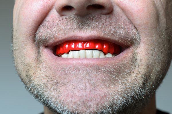 bruxism-clenching-teeth-night-grinding bruxism-clenching-teeth-night-grinding
