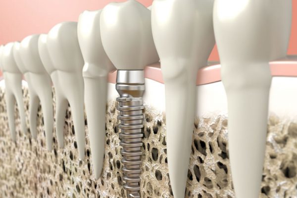 general-dentistry-implants