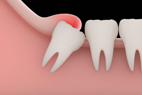 general-dentistry-wisdom-teeth