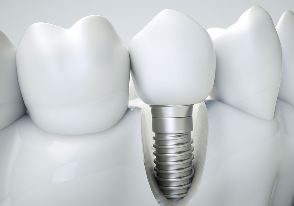 Dental Implants